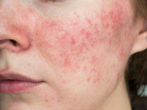 疫情時期肌膚潮紅發炎 日常保養 4 步驟遠離玫瑰斑