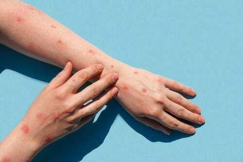 monkeypox disease patient with monkey pox rash hand close up rash human hands banner copy space