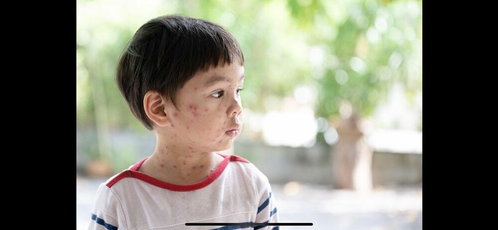 帶狀疱疹 每3人就有1人會得 疱疹後神經痛嚴重影響生活品質 - 台北郵報 | The Taipei Post