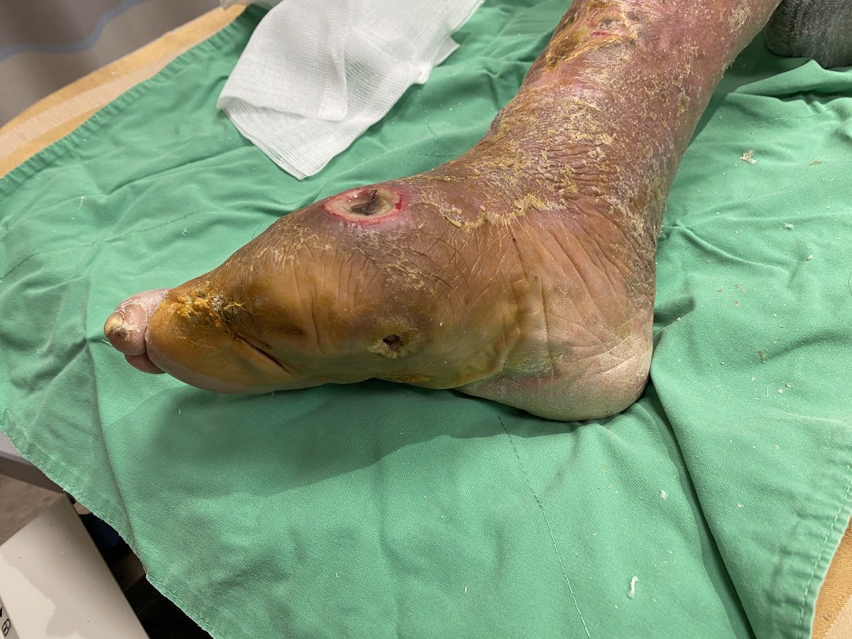糖尿病患腳底爛到小腿險截肢　員榮利用高壓氧治療及震波治療今已行走自如 - 台北郵報 | The Taipei Post