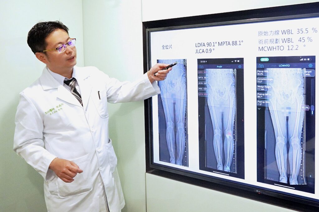結合「3D列印技術」矯正變形腳踝 聯新國際醫曝有這些優點