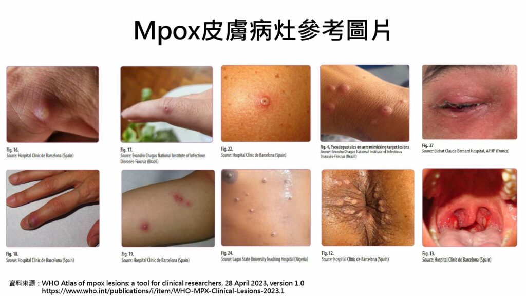 猴痘正名「m痘」-北榮桃園分院曝預防方式