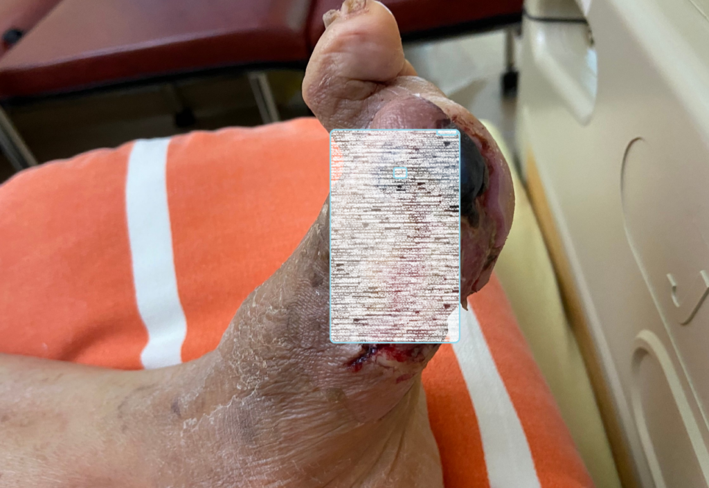 糖尿病患足部傷口不可輕忽-部桃：嚴重恐截肢 