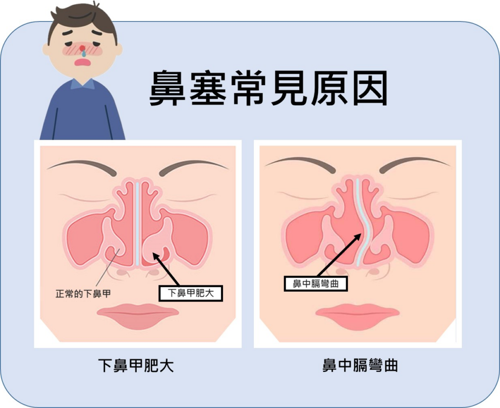鼻塞過敏反覆發作怎麼辦？醫師提醒早期診斷和治療是關鍵