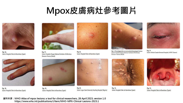 疾管署提升旅遊警示-籲民眾關注m痘疫情並加強防護措施